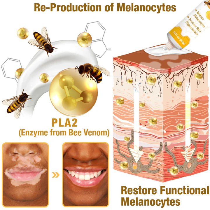 Crème de traitement contre le vitiligo BeeVenom Dobshow™