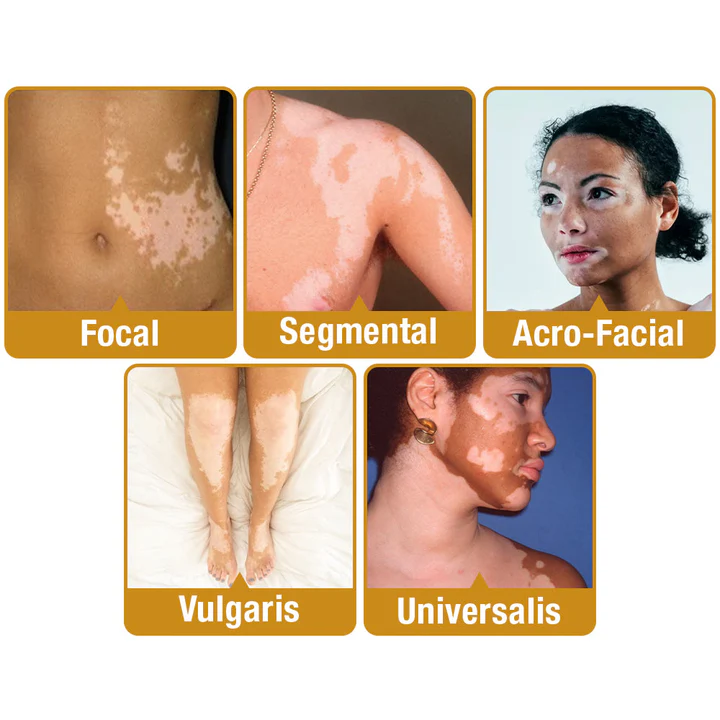 Crème de traitement contre le vitiligo BeeVenom Dobshow™